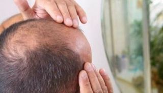 تقدم دوائي لعلاج الصلع