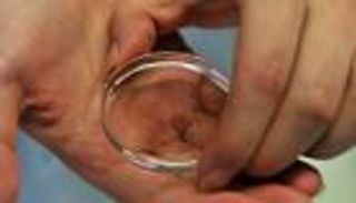 طفرة جينية لمتبرع بالحيوانات المنوية تصيب 179 طفلا بأوروبا بالسرطان