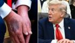 البيت الأبيض يوضح سبب الكدمات المتكررة على يد ترامب