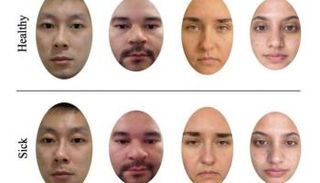 دراسة علمية تكشف أن النساء أكثر دقة من الرجال في تشخيص المرض من الوجوه