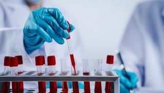 اختبار دم جديد يكتشف مرض العصبون الحركي مبكرا 