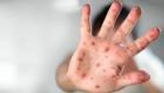 الحصبة تنتشر مجددا عالميا رغم انخفاض الوفيات منذ عام 2000