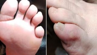 إصبع القدم الأيرلندي له مضاعفات خطيرة