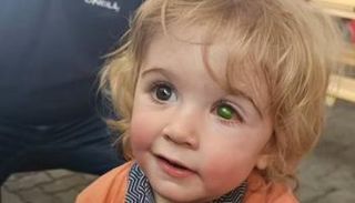 الطفل البريطاني جوان مهدد بفقدان عينه اليسرى