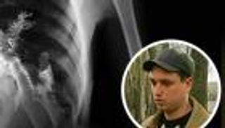 من الشجرة إلى السمكة.. 10 أجسام غريبة وجدت داخل المرضى