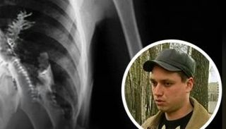 تفاجأ الأطباء في روسيا بعد العثور على شجرة صنوبر صغيرة تنمو داخل رئة 