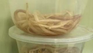 كمية كبيرة من الديدان العملاقة عزلت من جسد الطفل