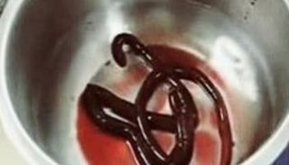 دودة عملاقة حمراء بطول 30 سم عثر عليها في مثانة مريض