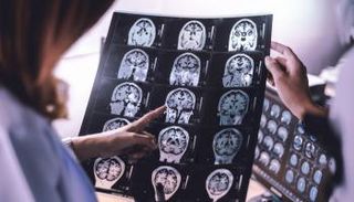 متلازمة عدم الخوف تحدث بسبب تلف في اللوزة الدماغية