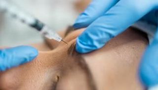 طبيبة تجميل برهنت على فعالية البوتوكس باستخدام نصف وجهها كـ"حقل تجارب" 