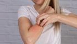 سن اليأس يفجر الإكزيما.. دراسة تكشف تأثير هرمونات النساء على الجلد