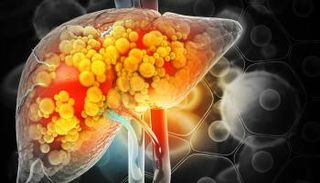 فطر " فوزاريوم فويتنز " أظهر كفاءة في علاج الكبد الدهني بالتجارب قبل السريرية