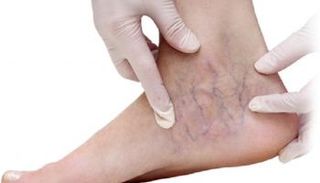 المصابون بدوالي الساقين أكثر عرضة للإصابة بالخرف