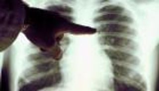 «سيبيل».. عرافة رقمية  تتنبأ بسرطان الرئة قبل ظهوره