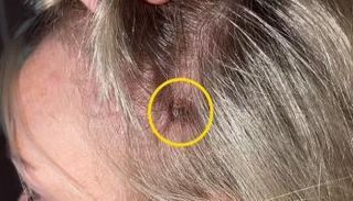 البقعة التي ظهرت في رأس ميكيلا بيكوك