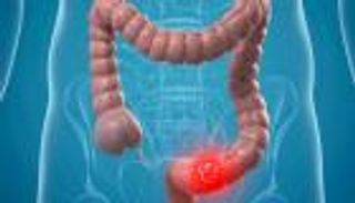 لماذا يصيب سرطان القولون شبابا أكثر من قبل؟