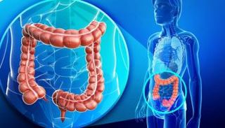 سرطان الأمعاء، أحد أكثر أنواع السرطان شيوعا في المملكة المتحدة