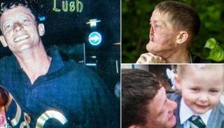 بريطاني أنفه بالكامل بعد أن ظن الأطباء لأشهر أن ما يعانيه عدوى تنفسية 