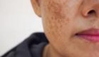 مدته دقيقة.. اختبار يكشف مدى تعرضك لخطر سرطان الجلد 