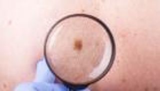 تحذير خطير.. سرطان الميلانوما قد يُخفي نفسه في الجلد السليم