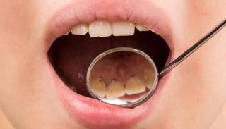 ابتكار أغشية تذوب في الفم لإصلاح الأسنان