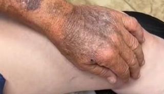 ذراع بلون بني داكن ومليئة بالتجاعيد والبقع بسبب إهمال الواقي الشمسي