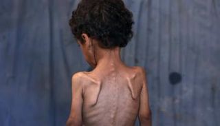 طفل في غزة يعاني من سوء التغذية