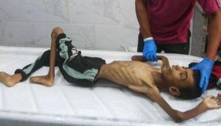 مسعف ينظف جثمان طفل فلسطيني توفي جوعًا في غزة