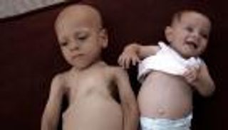 مأساة عبدالله وحبيبة أبوزرقة.. صغيران يصارعان الموت في غزة