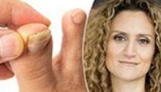 الدكتورة إيلي كانون قدمت نصائح للتعامل مع الأظافر الصلبة والقشرية