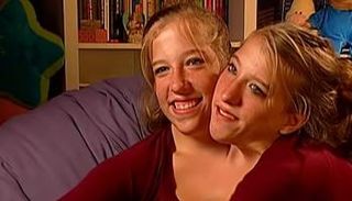 توائم هينسل المتلاصقتان 