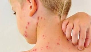 الحصبة تتراجع في تكساس