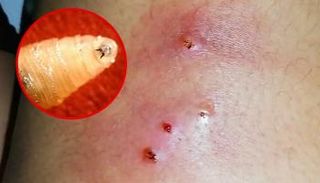 يرقات الدودة تحفر اللحم الحي باستخدام أفواهها الحادة