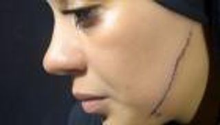 قبل أيام من الزفاف.. القبض على مطلقة اعتدت على عروس طليقها بـ41 غرزة