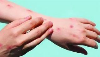 إصابات جدري القرود في غانا