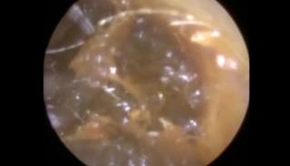 صورة للشمع المتراكم في الأذن