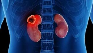 6 إشارات مبكرة تكشف سرطان الكلى الصامت