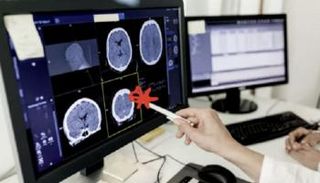  دهون الدماغ قد تكون مفتاح علاج ألزهايمر