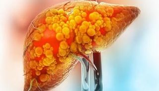 باحثون كنديون كشفوا عن دور بكتيريا الأمعاء الضارة في زيادة حالات سرطان الكبد