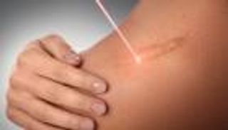 أمل جديد لمرضى الندبات الجلدية.. دواء موضعي يحقق نتائج مشجعة