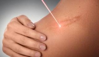 دواء موضعي يحقق نتائج مشجعة  في علاج الندبات الجلدية