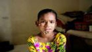 «متلازمة الرجل الشجرة».. التفاصيل الكاملة عن المرض بعد انتشاره في بنغلادش