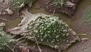 صورة مجهر مسح إلكتروني لخلية سرطان رئة