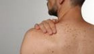 مكمل غذائي شائع يثبت فاعليته في الوقاية من سرطان الجلد