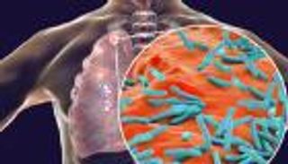 علماء يكشفون سر قوة السل.. البكتيريا تعطل إنذار المناعة المبكر