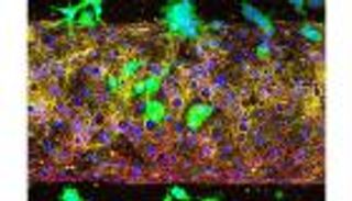 الكشف عن السلاح الخفي الذي يغذي انتشار سرطان البنكرياس