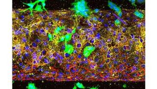الكشف عن السلاح الخفي الذي يغذي انتشار سرطان البنكرياس