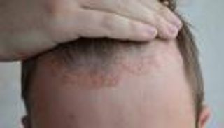 دواء مناعي يغيّر &laquo;ذاكرة الجلد&raquo; ويمنع عودة الصدفية