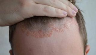 استخدام جرعات أعلى من دواء "ريسانكيزوماب" يمنع عودة الصدفية  