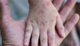 الصحة الأمريكية تحذّر من أعلى معدل إصابات بالحصبة خلال 2025